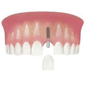 Implant i nje dhembi