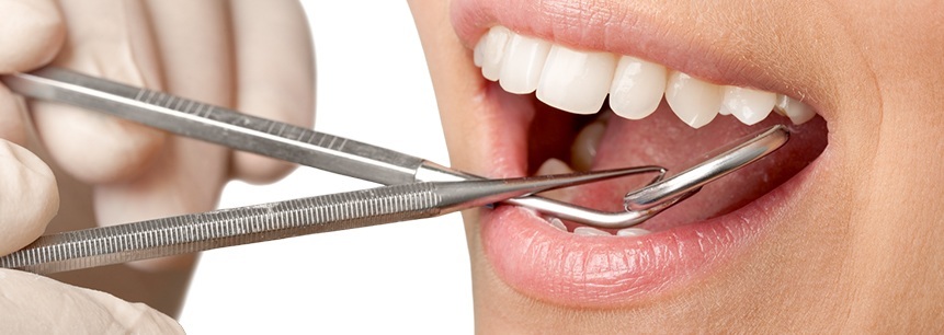 zbardhja e dhëmbëve